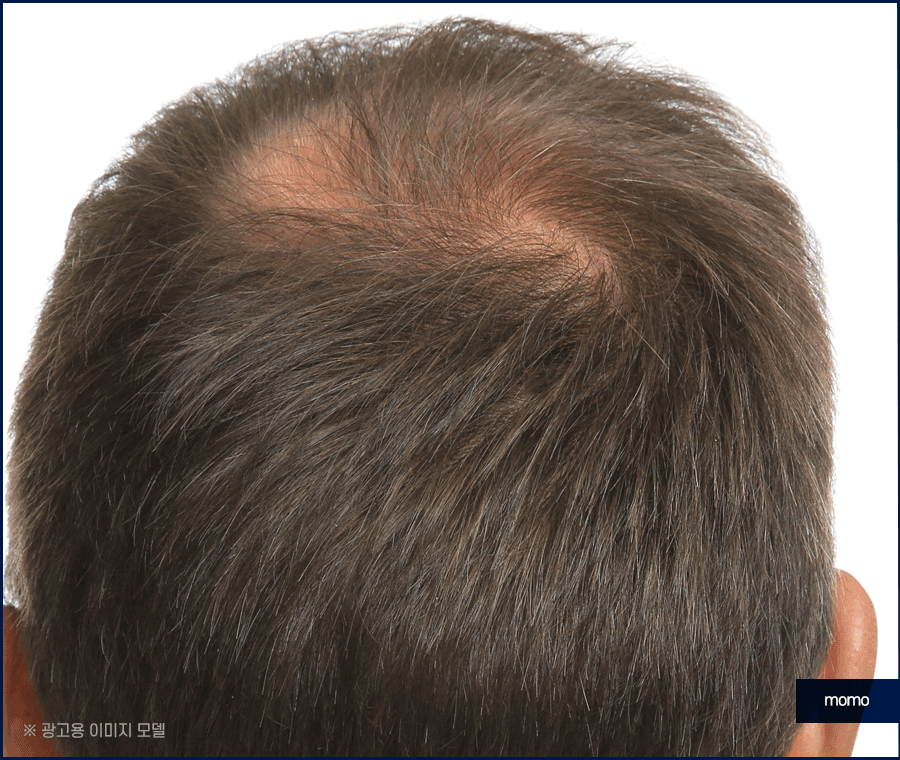 강남 탈모 병원 원인 파악부터 철저하게 시작하는 곳 관련 이미지 8