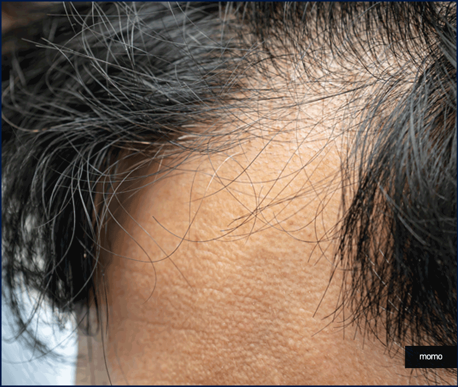 모발이식전후 확인 중이라면 꼭 체크할 핵심 요소 관련 이미지 8