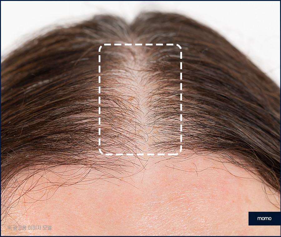 여자 정수리 탈모 모발이식 꼼꼼히 채우는 관련 이미지 8