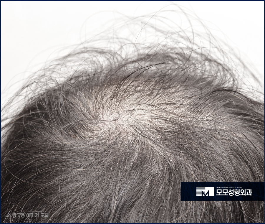 안드로겐성탈모 원인과 개선을 위한 방안은 관련 이미지 4