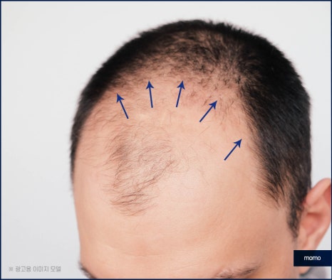 헤어라인 교정 비용 및 방법 디자인의 중요성 관련 이미지 7