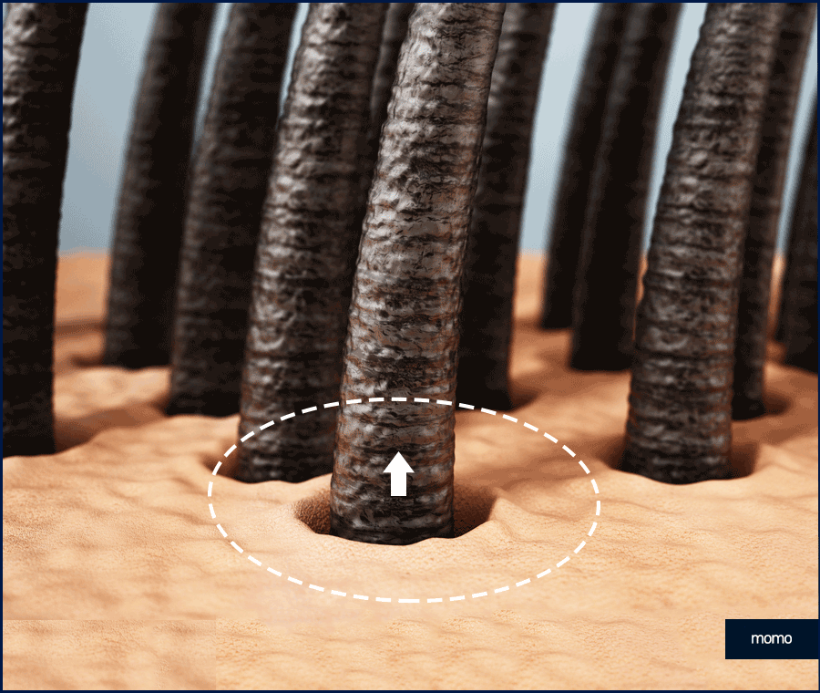 여자 모발이식 헤어라인 교정이 필요하다면 관련 이미지 7