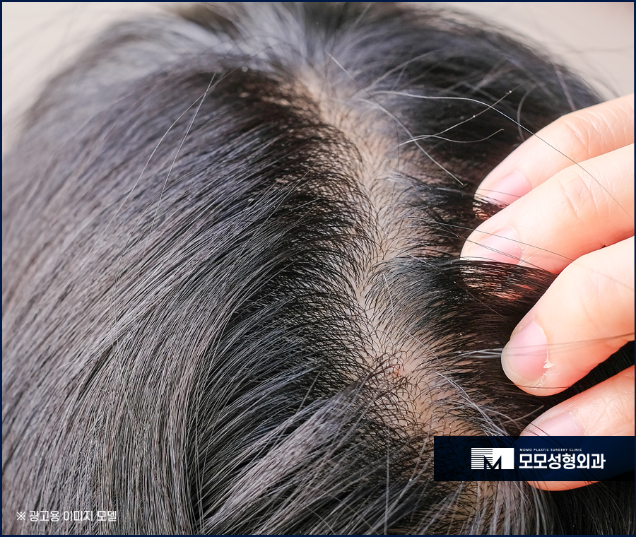 모발이식병원추천시 잊어서는 안 될 관련 이미지 2
