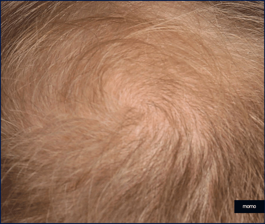 M자탈모치료 모발이식이 특별한 이유 3가지 관련 이미지 11