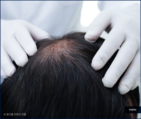 압구정역 모발이식 방법 및 생착률을 높이는 팁 관련 이미지 6