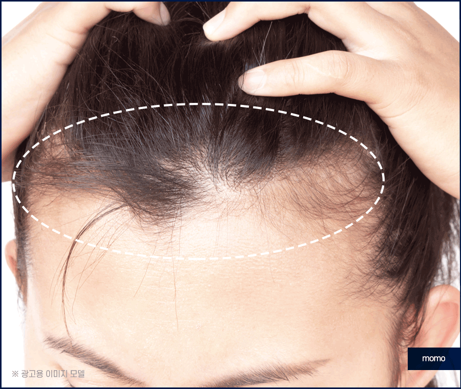 압구정모발이식 원하던 모습을 찾는 포인트 관련 이미지 4