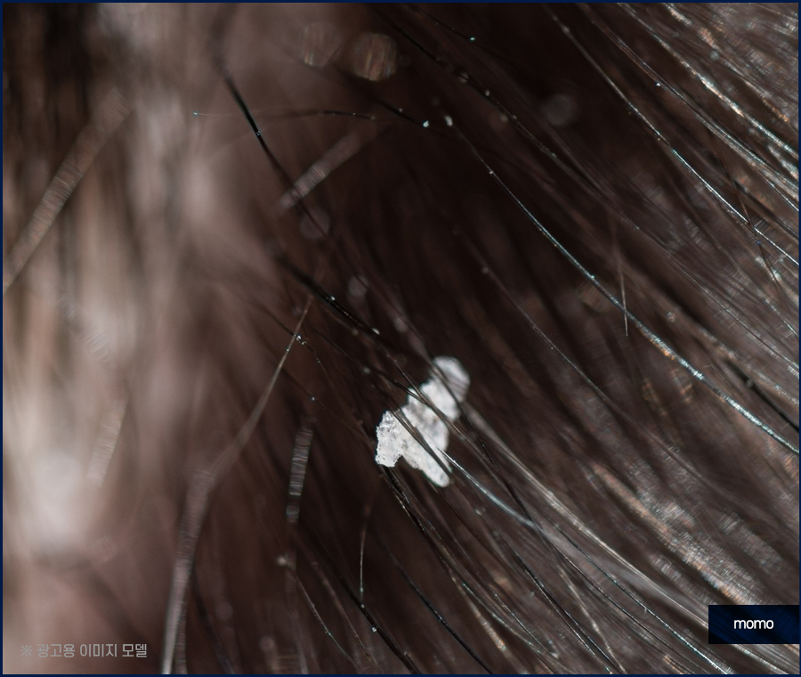 머리비듬없애는법 효과적인 비결에 대해 관련 이미지 4