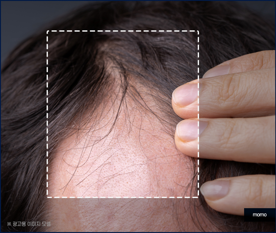 m자 모발이식 가격 달라지게 되는 이유는 관련 이미지 8