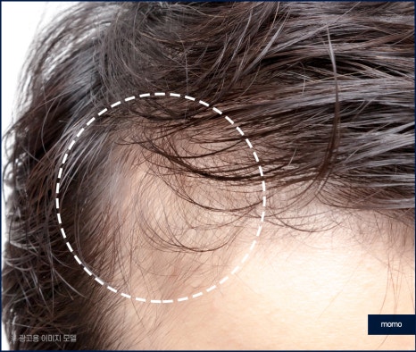 모발이식 후기 비교하며 섬세한 분석까지 해야만 관련 이미지 4