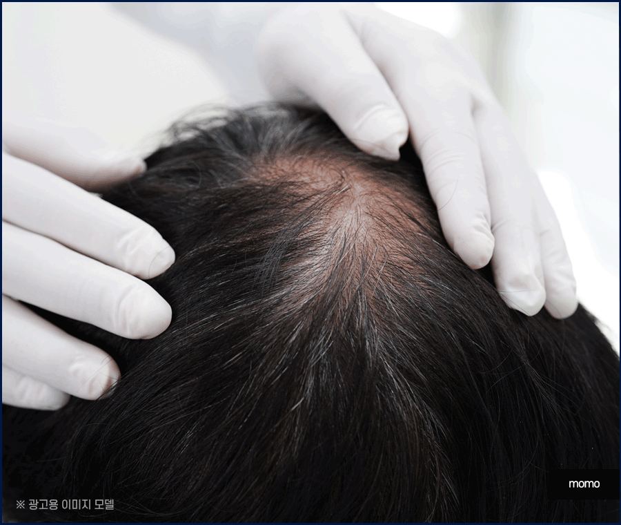 비절개 모발이식 후기와 함께 꼭 알아볼 이것! 관련 이미지 11
