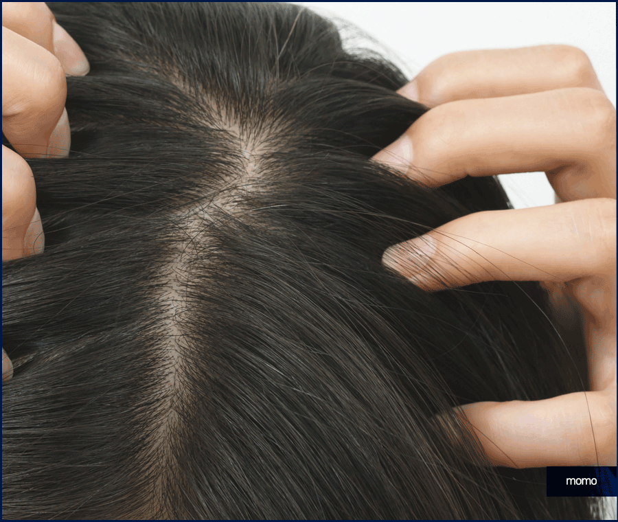 여자 가르마 탈모 모발이식으로 효과보려면? 관련 이미지 8