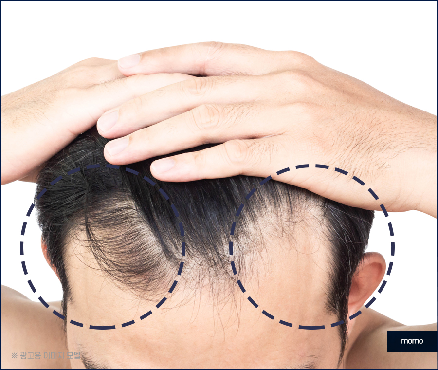 비절개 모발이식 비용 무삭발로 회복까지 빠르게 관련 이미지 4