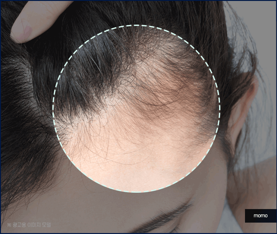 출산후 탈모 자연스럽게 보완하는 방법은 관련 이미지 5