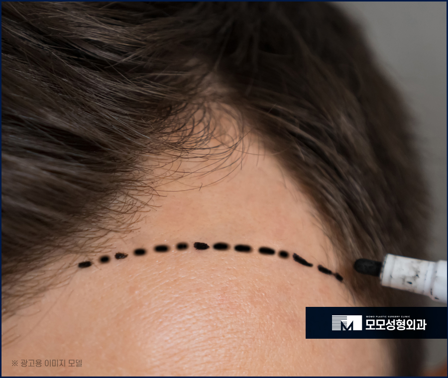 M자탈모병원 깊이 파인 헤어라인이 고민일 경우 관련 이미지 5