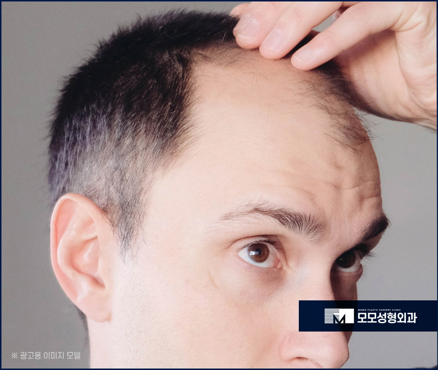 모발이식개구리알 발생 이유와 생착률과의 관계 관련 이미지 2