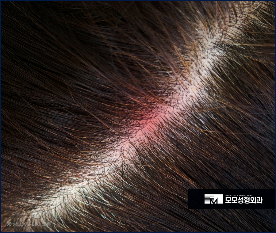 모발이식 한달 어떤 변화가 나타나며 주의할 점은 관련 이미지 6