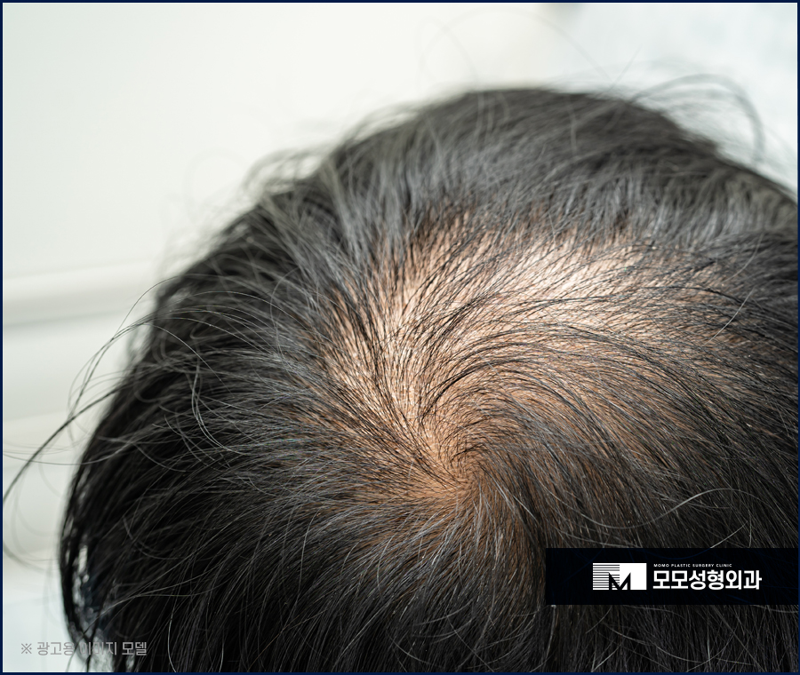 모발이식 재수술 실수가 다시 나타나지 않는 방향으로 관련 이미지 3