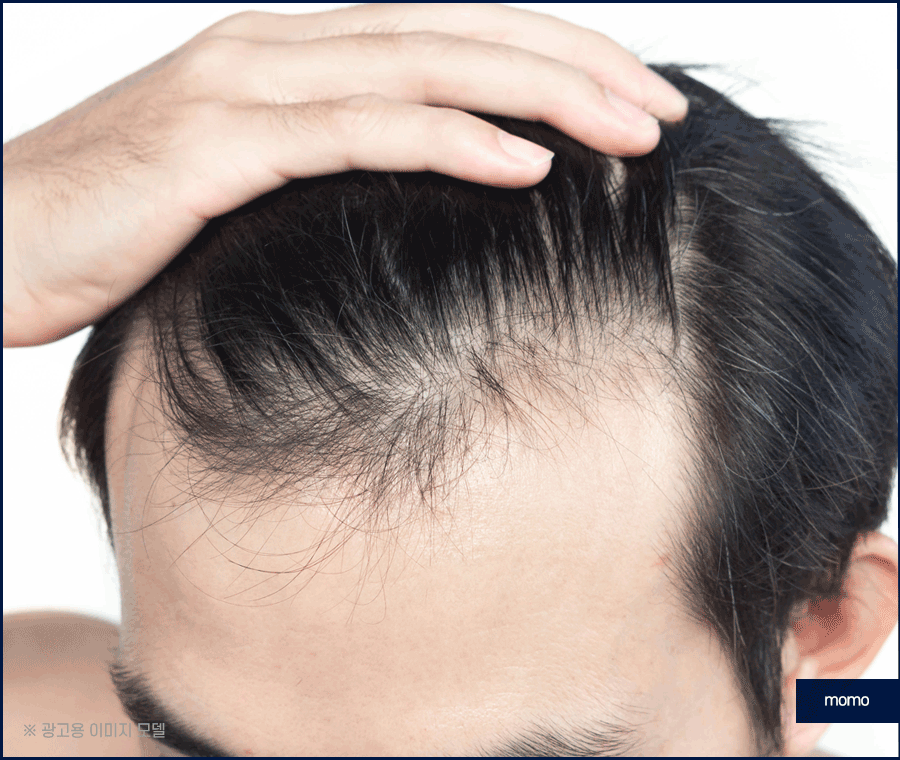 비절개 모발이식 후기와 함께 꼭 알아볼 이것! 관련 이미지 6