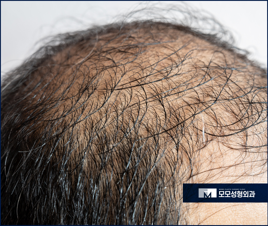 비절개모발이식가격 호전되는 방향으로 관련 이미지 3
