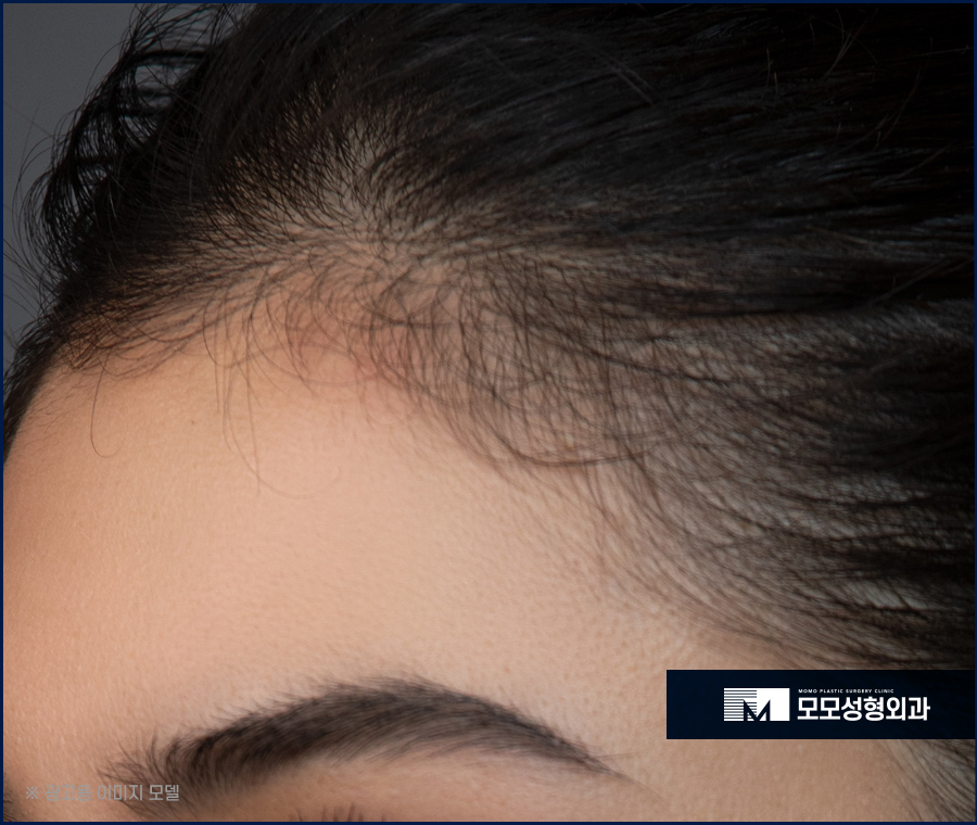 여성헤어라인모발이식 보강이 필요하다면 관련 이미지 7