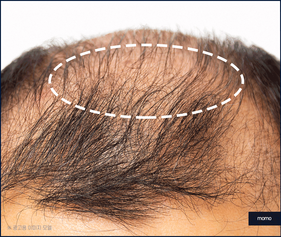 압구정모발이식 원하던 모습을 찾는 포인트 관련 이미지 7