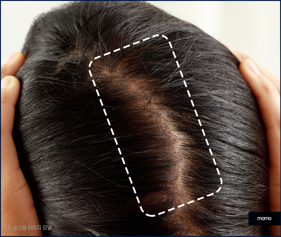여자 정수리 탈모 모발이식 꼼꼼히 채우는 관련 이미지 4
