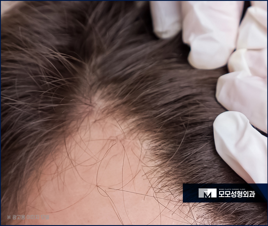 여자M자탈모 사전 예방법부터 발생 시 대처하는 방법 관련 이미지 4