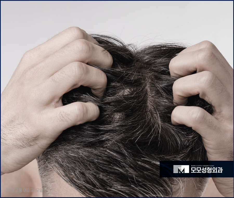 미녹시딜 5% 효과와 사용 전 알아두어야 할 점 관련 이미지 9