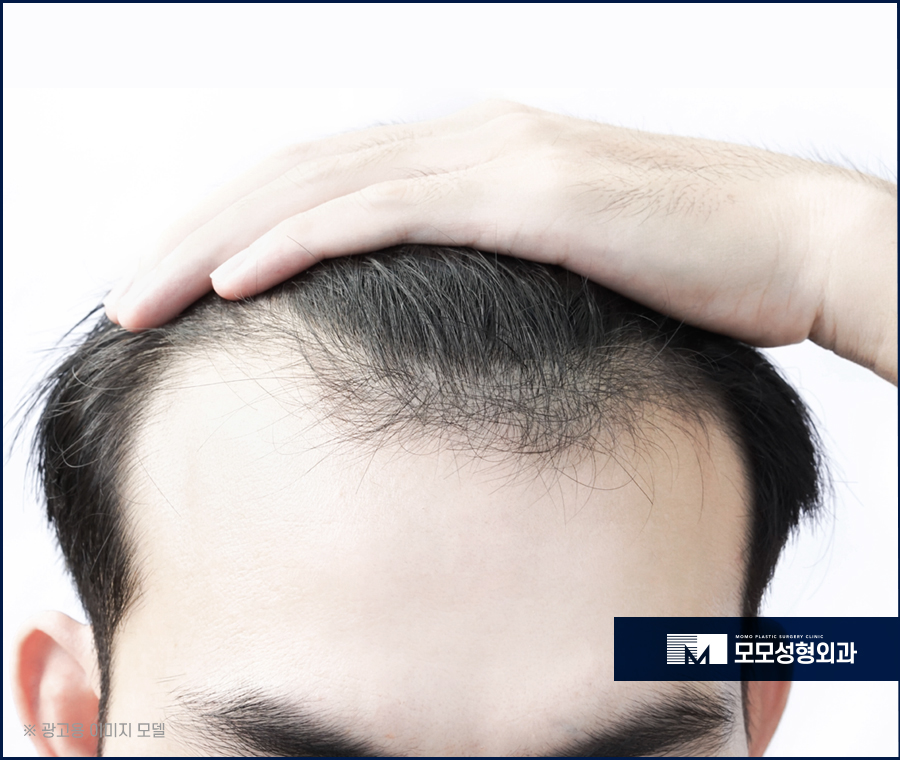 M자이마모발이식 빈 곳을 섬세하게 보완하며 관련 이미지 2