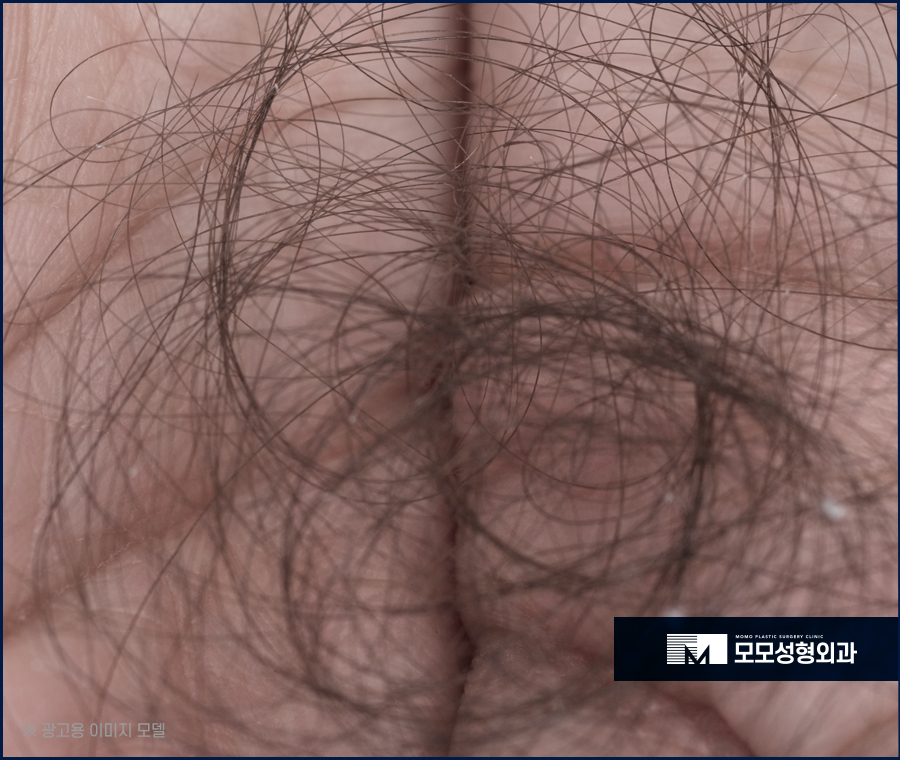 서울 모발이식 오랜 고민을 이겨내기 위한 선택 관련 이미지 6