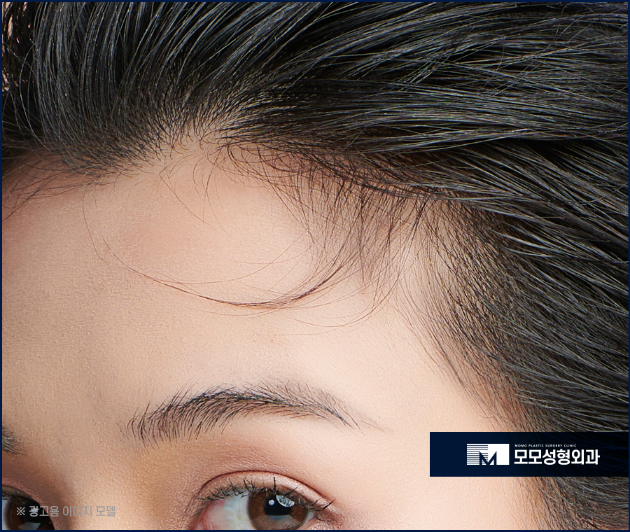 여성헤어라인모발이식 채워 주기 위한 방법은 관련 이미지 4