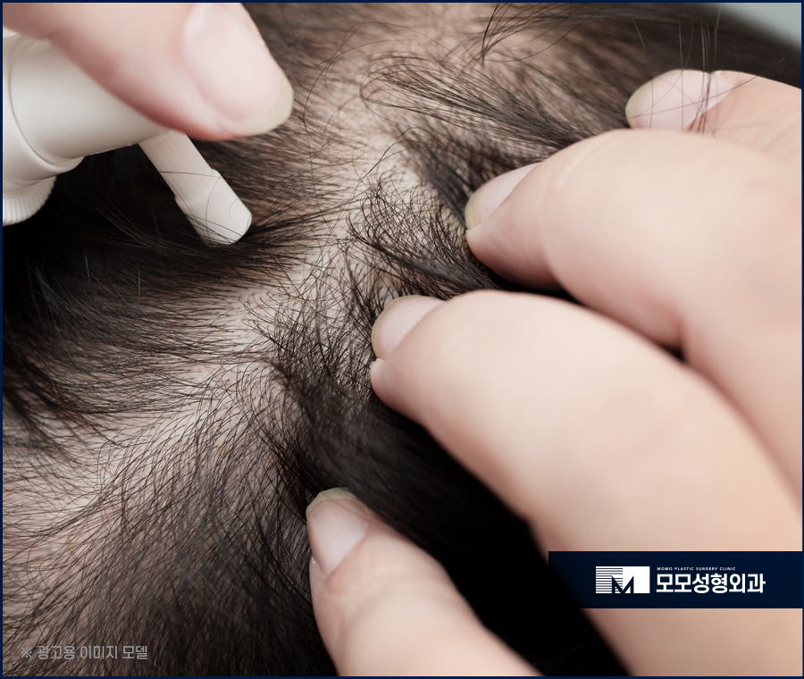여자가르마탈모 수복을 위한 시술은 관련 이미지 3