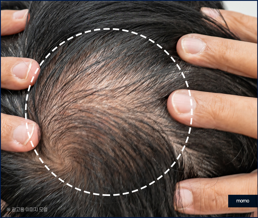 비절개 모발이식 비용 개인차를 고려해서 관련 이미지 4