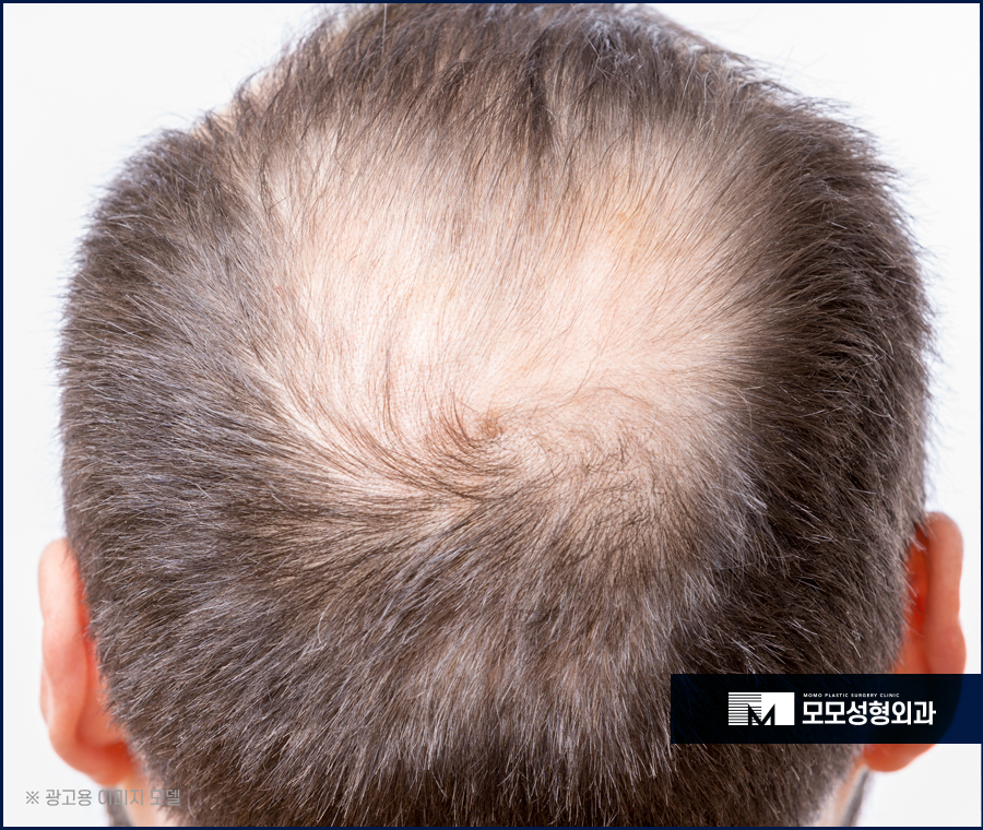 이승아원장 비절개 노컷 모발이식 관련 이미지 3