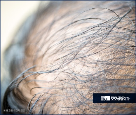 머리심는비용 비절개가 선호되는 이유에 대해 관련 이미지 5