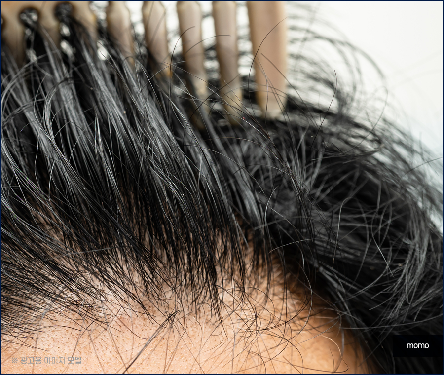 돼지털 머리카락 원인 및 완화하는 방법 3가지 관련 이미지 7
