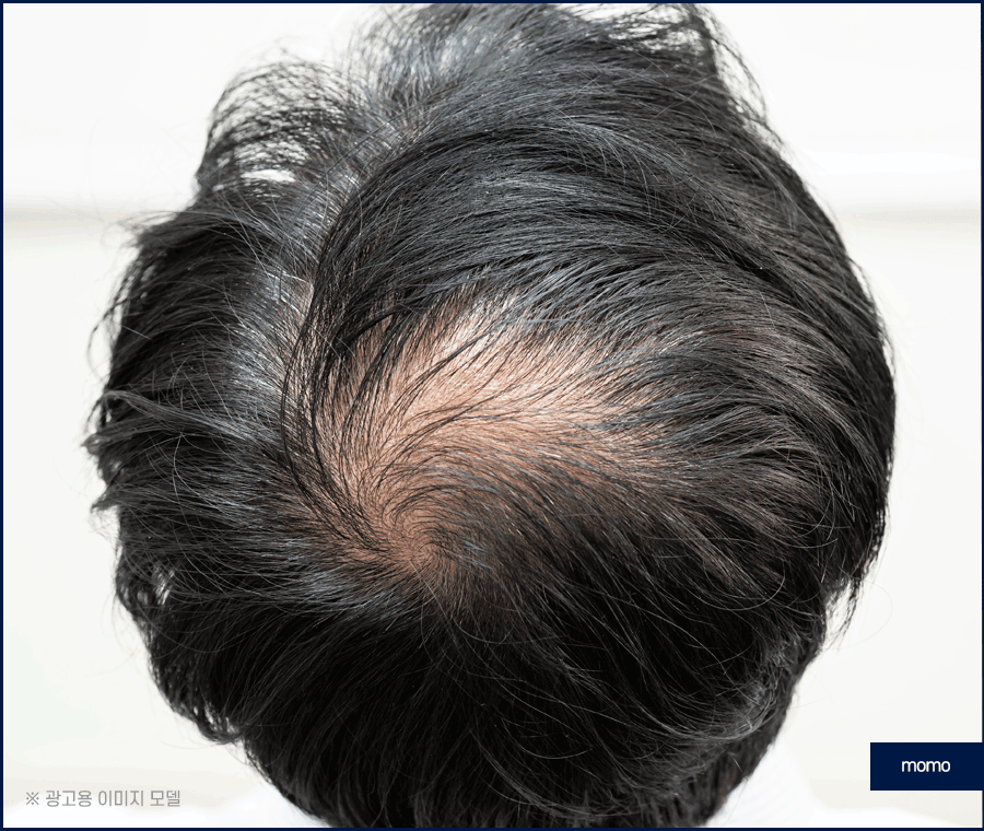 모발이식 생착률 높이기 위한 솔루션은 관련 이미지 10