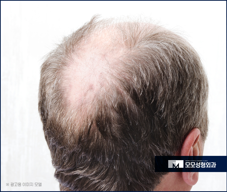 강남역탈모병원 풍성한 모습을 완성하기 위한 곳 관련 이미지 3
