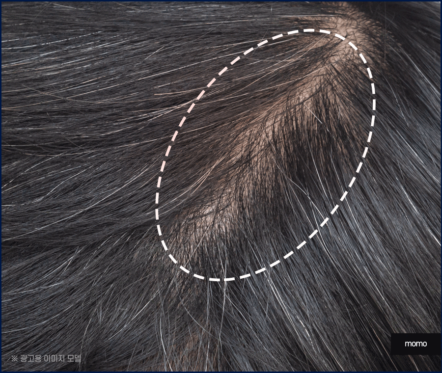 압구정모발이식 원하던 모습을 찾는 포인트 관련 이미지 10