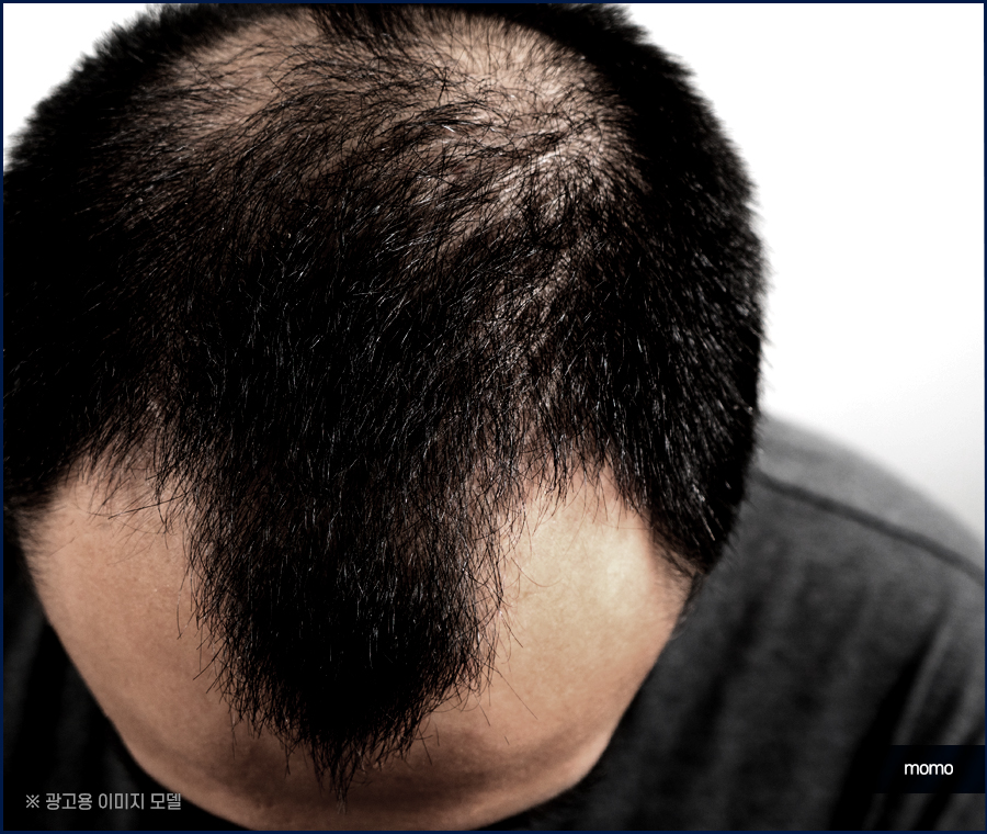 남자 헤어라인 교정 불규칙한 라인 보완을 위해 관련 이미지 4