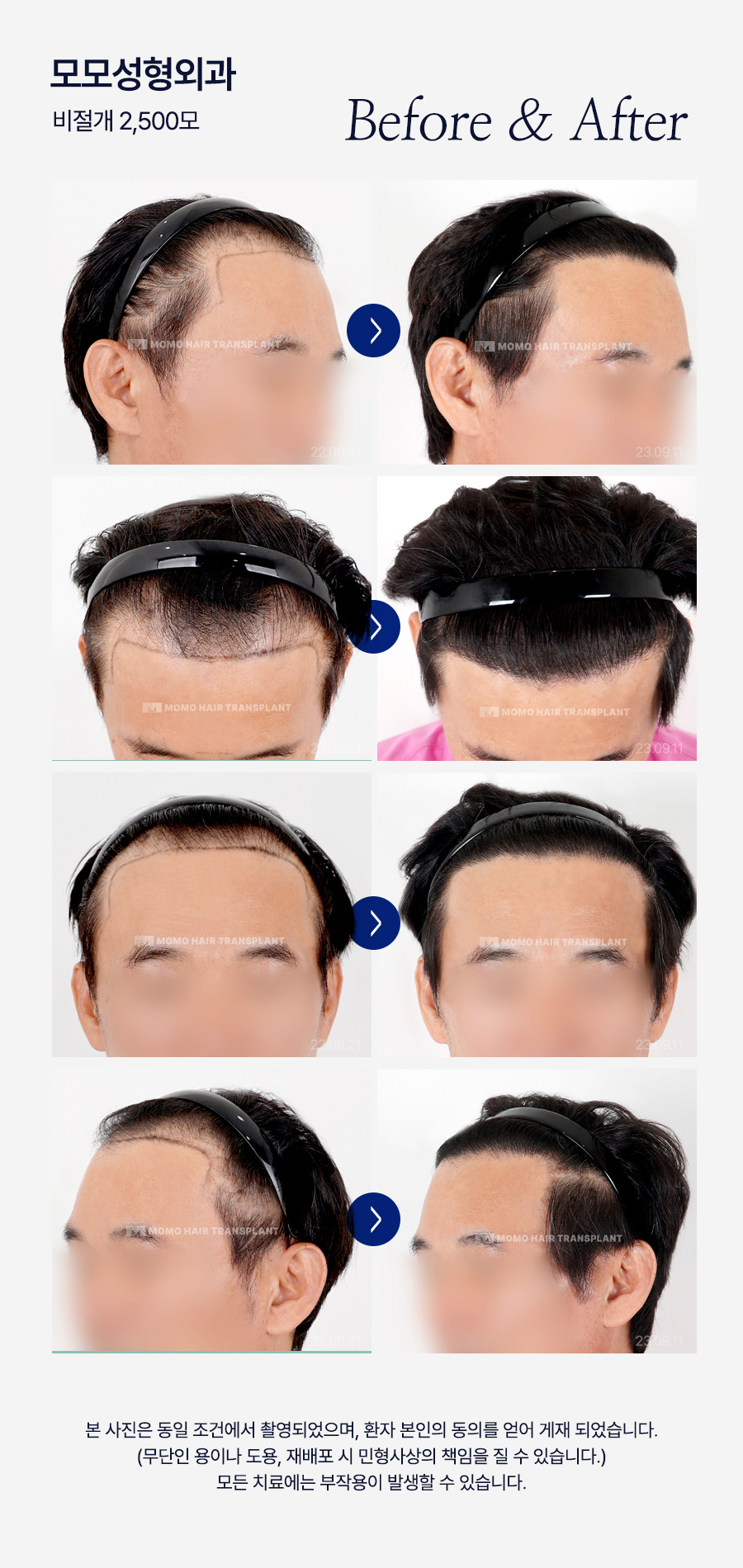 비절개 모발이식 후기와 함께 꼭 알아볼 이것! 관련 이미지 15