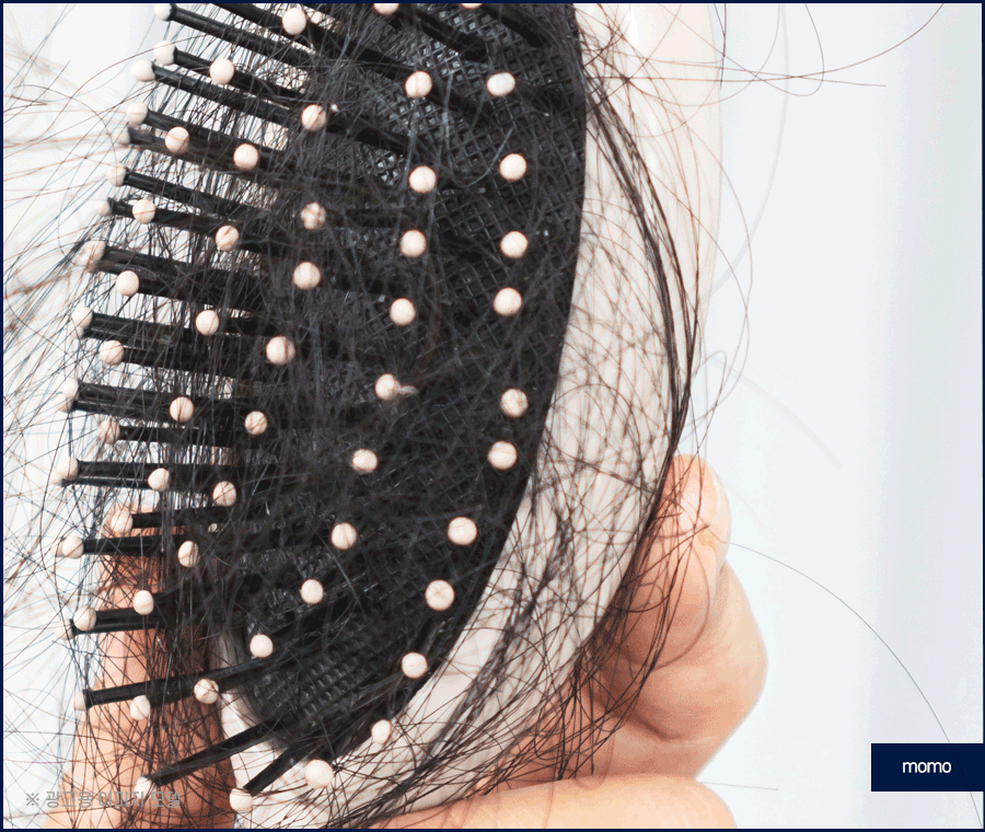 헤어라인 모발이식 비용보다 꼼꼼히 알아볼 조건은? 관련 이미지 3