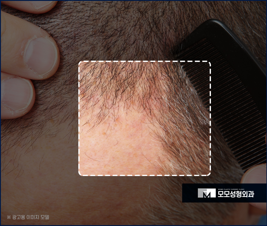 M자 모발이식 비용과 금액대가 달라지는 이유 관련 이미지 4