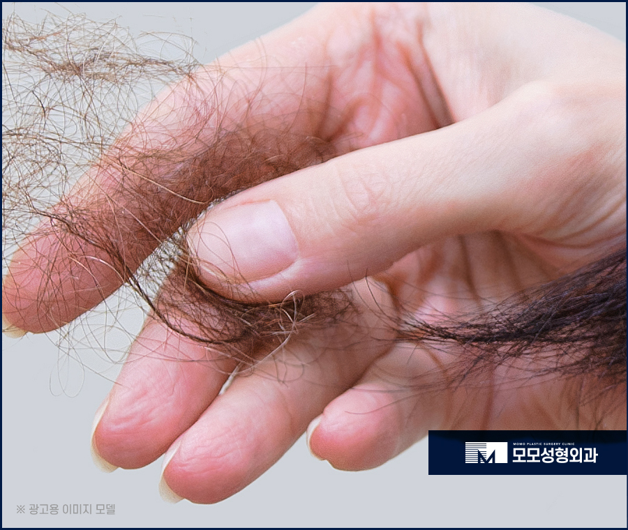 여자M자이마탈모 개인맞춤 진행의 중요성에 대하여 관련 이미지 3