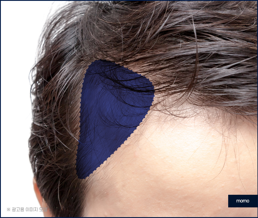 압구정탈모병원 절개가 부담스러울 경우 대안까지 관련 이미지 9
