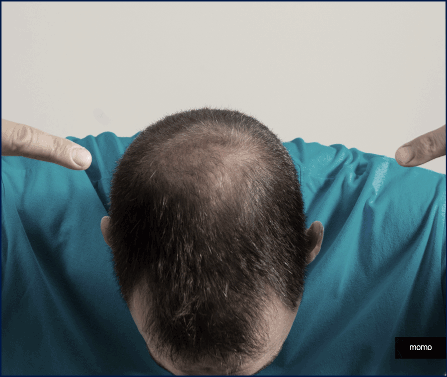 20대 모발이식 성공적인 결과를 위한 필수 조건 관련 이미지 3