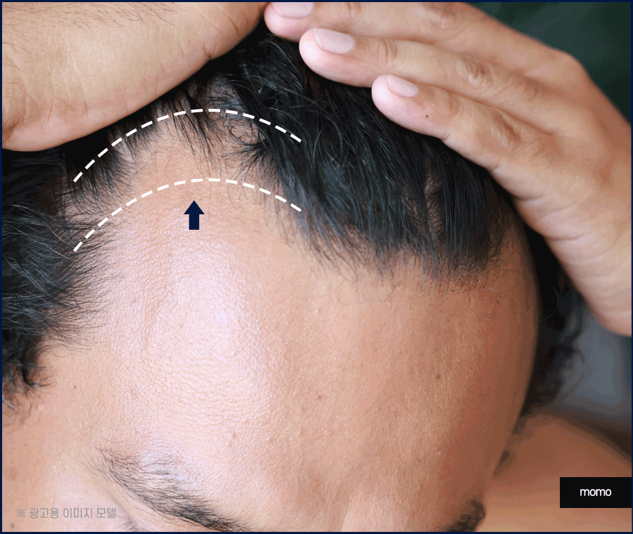 M자탈모치료 모발이식이 특별한 이유 3가지 관련 이미지 10