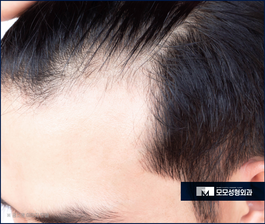 남자엠자탈모 극복을 위한 방향을 잘 잡아야만 관련 이미지 4