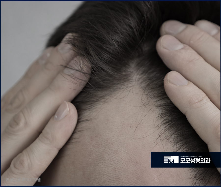 여자헤어라인모발이식 이마 높이 변화로 작은 얼굴 효과 관련 이미지 3