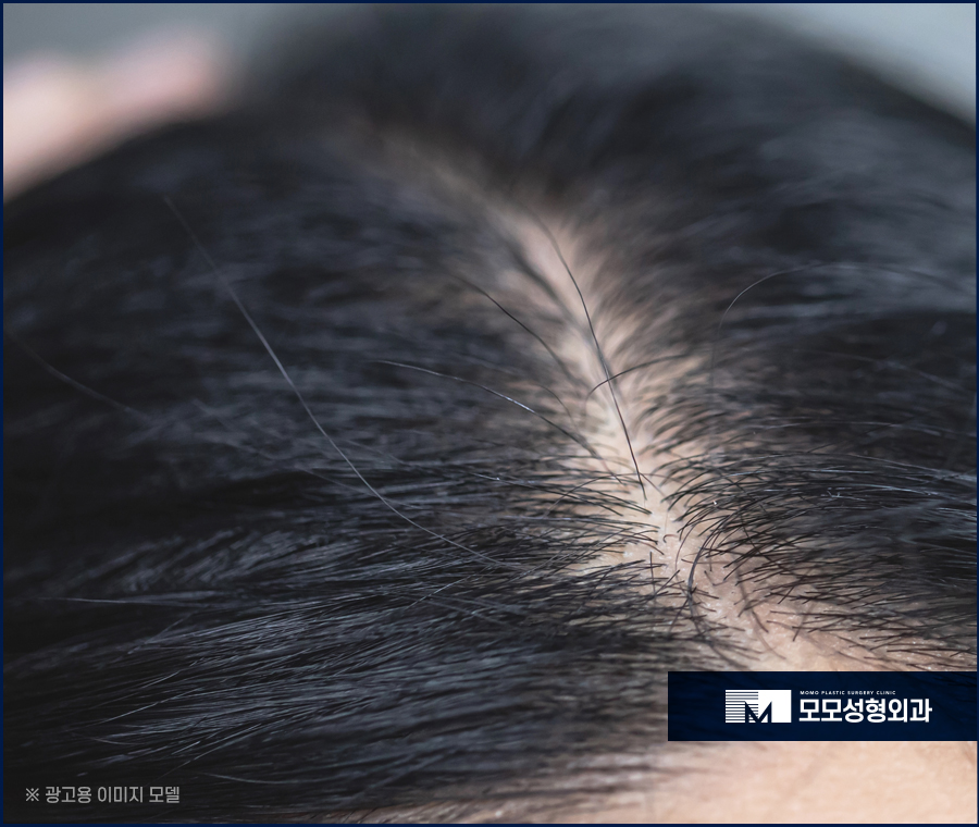 미녹시딜 5% 효과와 사용 전 알아두어야 할 점 관련 이미지 2